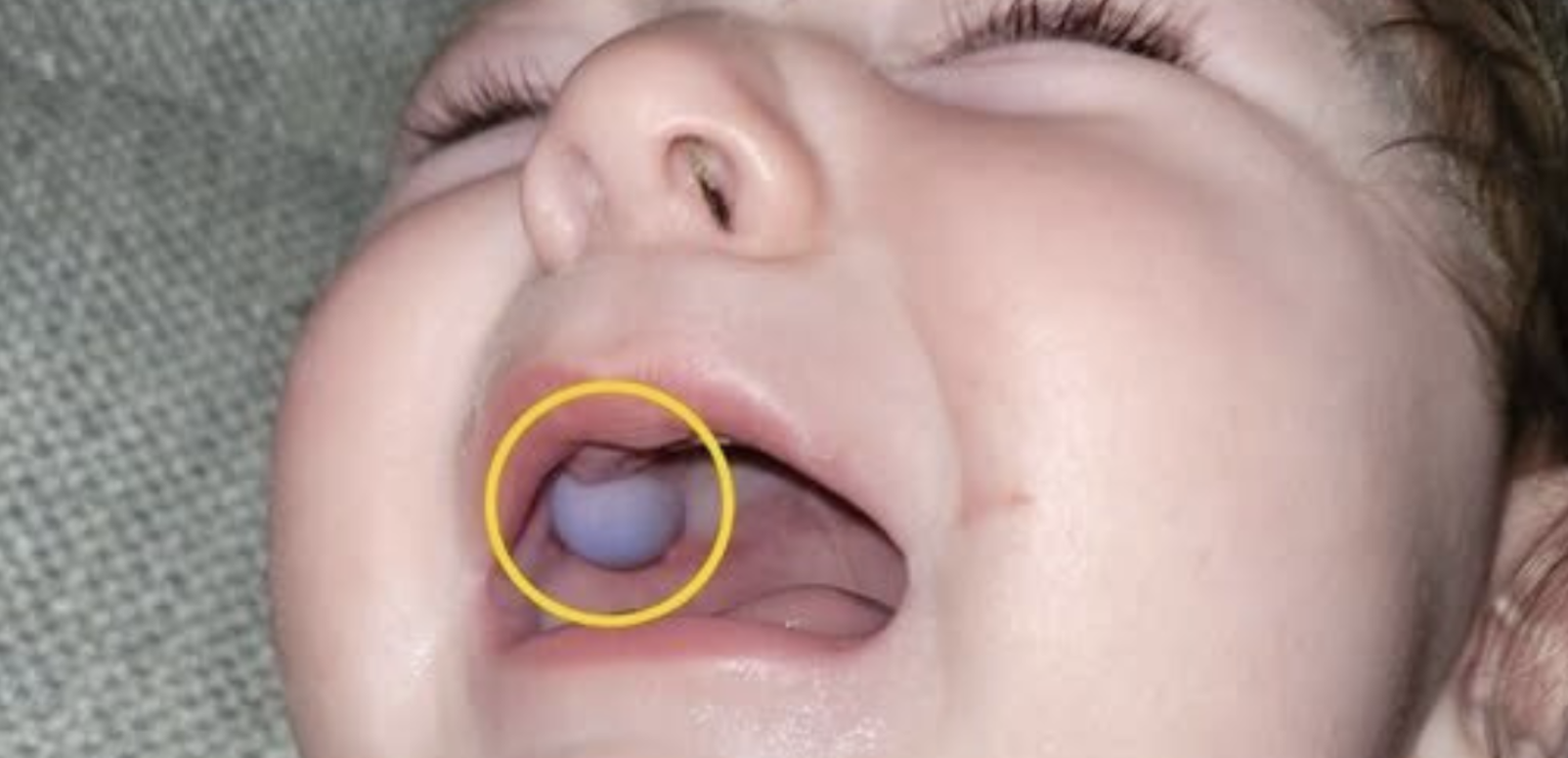 Artsen dachten dat de baby een tumor in haar mond had maar de waarheid sloeg iedereen met stomheid